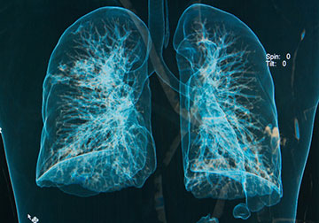 lung-xray